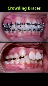 Magic braces From crowding teerh to perfect teeth #braces #orthodontist #dentist #teeth
