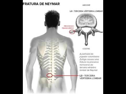 Neymar Back Injury in Hospital LIVE Video on Stretcher in pain