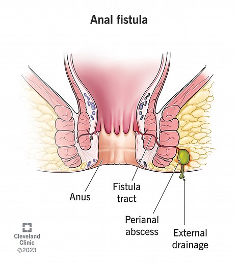 What Is An Anal Fistula?