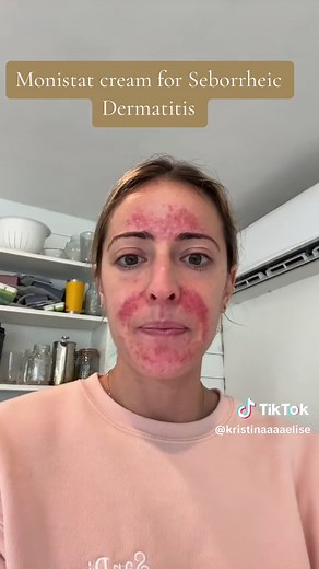 Monistat Cream for Seborrheic Dermatitis