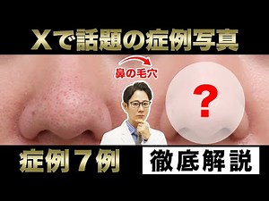 【毛穴/ニキビ跡/酒さ】Xでバズった症例をご紹介