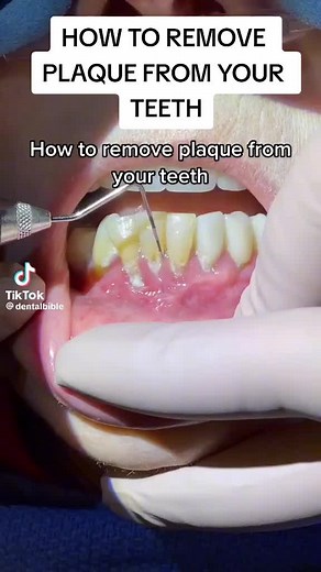 Effective Ways to Remove Plaque from Your Teeth at Home