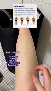 Lipedema shows up differently for everyone, but knowing the stages can help you recognize the signs early 💜 ✨ Stage 1: Skin still looks smooth, but nodules start forming under the skin. ✨ Stage 2: Skin gets uneven, with dimpling and more obvious nodules. ✨ Stage 3: Larger masses of tissue form, causing shape changes in the legs/arms. ✨ Stage 4: Lipedema lymphedema (often called lipo-lymphedema). Another symptom many don’t talk about? Itching. This can be linked to histamine release, inflammatio