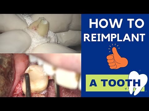 Intentional REIMPLANTATION of a TOOTH - Extraction and replacement in its socket - Live surgery