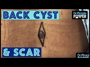 When you have a Per-CYST-ent Back