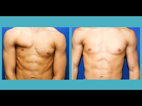 WHAT IS POLAND SYNDROME? Symptoms, Treatment