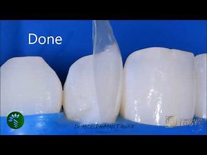 black triangle closure in 30 minutes using Bioclear Matrix