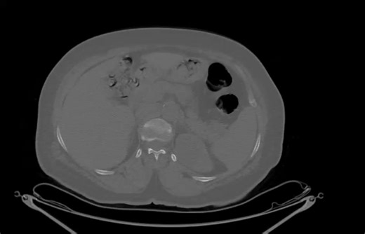► Fractured left sacral ala traversing left sacro-iliac joint and extending to left posterior iliac bone with surrounding callus formation ► Left superior pubic bone and acetabular anterior column and roof fractures with surrounding callus formation ► Left l2 down to L5 transverse processes fractures in place ► Mild spondylodegenerative changes of the lumbar spine are noted, evident by tiny marginal osteophytes at the vertebral endplates ► Diffuse osteopenic texture of the examined vertebrae is 