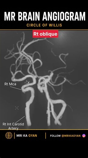 MR Brain Angiogram | Circle of Willis #radiology #mri
