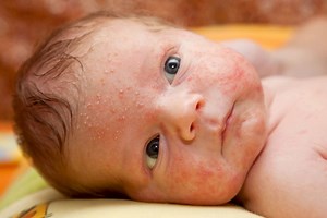 Baby Acne: Causes & Treatments of Baby Acne