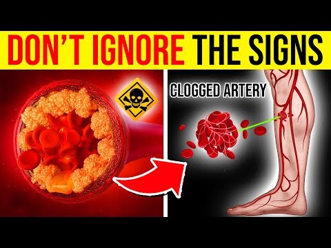 8 WARNING Signs You Have A CLOGGED Artery! (DON'T IGNORE)