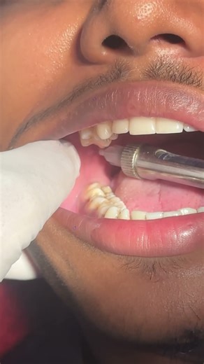 dental anesthesia #dentist #dental