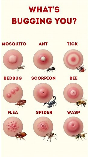 Can You Identify These Bug Bites?