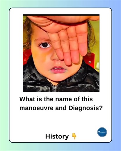 H.N.Ali (Dx & Tx)✨ on Instagram: "✨ Dr Medica | Clinical Cases ✨ A patient is shown undergoing an eye examination where one eye is covered and then uncovered while observing movement of the other eye. 👉 Ask: • What is the name of this maneuver? • What is the most likely diagnosis? 👁️🧠 #Ophthalmology #ClinicalSigns #EyeExamination #MedicalQuiz #DrMedica"