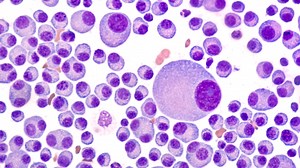 Mayo Clinic Minute: What is multiple myeloma? - Mayo Clinic News Network