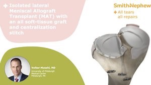 Isolated lateral Meniscal Allograft Transplant (MAT) with an all-soft tissue graft and centralization stitch