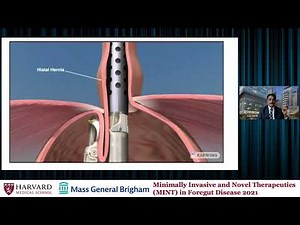 Interventions for reflux: endoluminal therapies- TIF