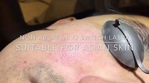 Asian Skin Rejuvenation Using Q-Switch Laser