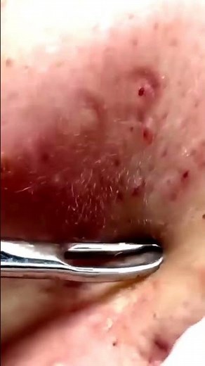 Acne Treatment NEW 2025 / blackheads and whiteheads removal #blackheads #acne #acnetreatment