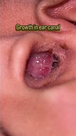 Inflammatory / Reactive Aural Granulation Tissue #medicaleducation