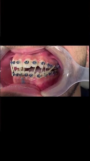 Open bite orthodontic treatment , Before & After Case