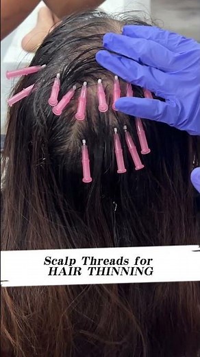 ✨Scalp Threading (PDO) Treatment for Hair Regrowth, Hair Thinning & Hair Loss | Hair Derma Clinic