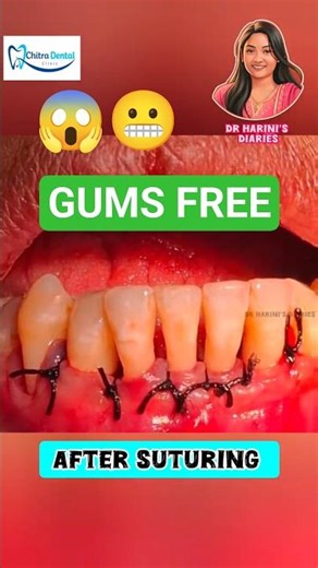 ROOT PLANING SAVED MY GUMS!! 😰😍 Must to do Gum care😬