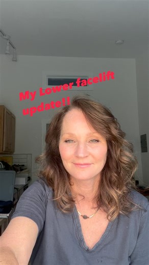 Patsy Russell | 45 day facelift update !! @peggylynnmarchetti @emmyroserussell | Instagram