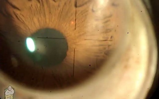 【中英双字】【激光虹膜切除术一例】Laser peripheral iridotomy (LPI)