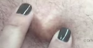 Viral Cyst-Pop Is The Lesion Of Doom