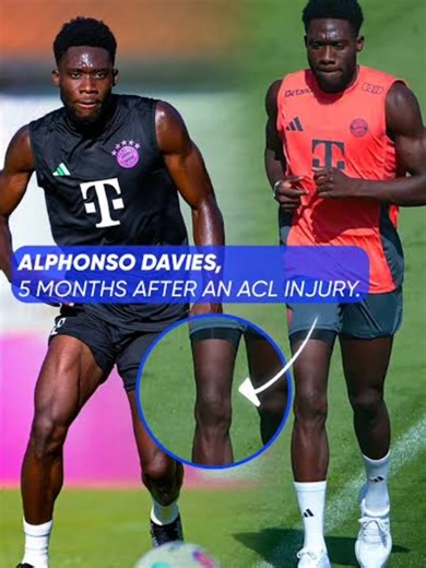 ‎Arthrogenic Muscle Inhibition (AMI)(ከACL እና ጉልበት ጉዳት በኋላ የሚከሰት የጡንቻ መዘጋት ችግር) is one of the biggest reasons athletes struggle to regain full quadriceps strength after an ACL injury or surgery. ‎It’s not just “weakness” AMI is a protective reflex from the knee joint that shuts down the quad, slows rehab, increases re-injury risk, and delays return to sport. ‎ ‎Don’t wait until it becomes chronic early rehab matters. ‎ ‎በDagiphysio Sports Rehab Center ‎We support athletes with modern, evidence-ba