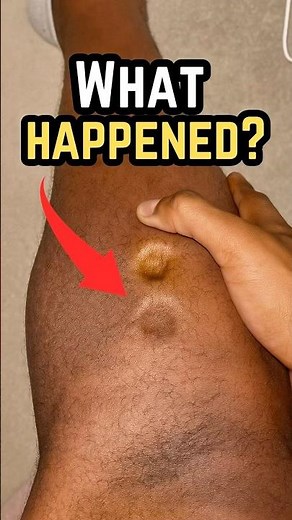 Understanding Pitting Edema: Causes and Care