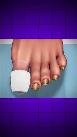 Professional Care and Treatment for an Infected Ingrown Toenail #IngrownToenail#FootCare#youtoub