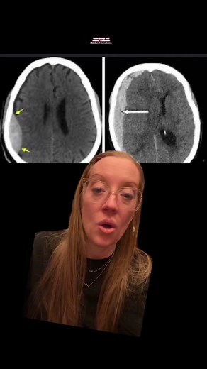 Case study 105 - Acute Subdural Hematoma @Ladyspinedoc⚡️ | Dr. Grunch 🧠 @Ladyspinedoc⚡️ | Dr. Grunch 🧠 Subdural hematoma can be a medical emergency. It’s usually caused by a head injury strong enough to burst blood vessels. This can cause pooled blood to push on the brain. Age, blood-thinning drugs, and alcohol abuse increase risk. #neurosurgery #casestudy #sundaycasestudy #ladyspinedoc #healthcareworker #hospital #surgery #neurosurgeon #medicalschool #medstudent #medicalstudent #nursing #past