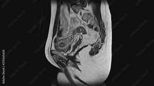 MRI of the female pelvic organs, abdominal cavity, gastrointestinal tract and bladder Stock Video
