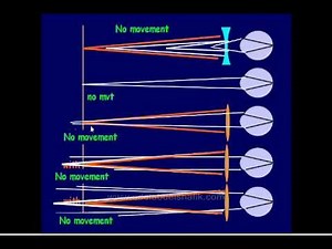 Optics : Retinoscopy Part One (in Arabic)