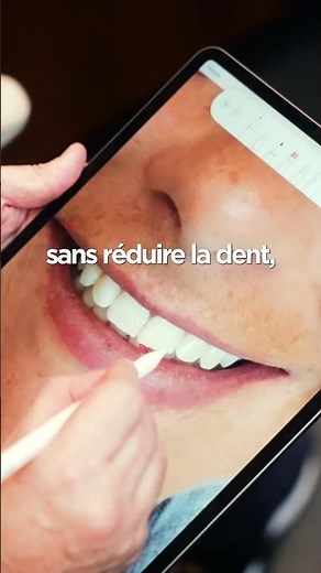 Facettes dentaires sans meulage. Elone Clinic Paris