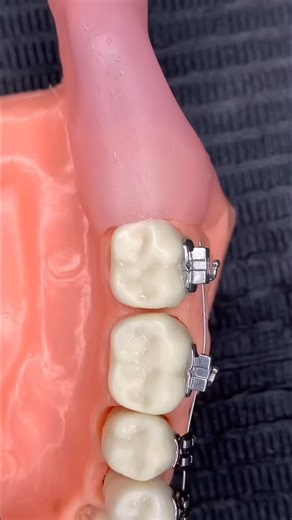 Dentistry My World 🌍 on Instagram: "Wisdom tooth extraction 💪🏻"