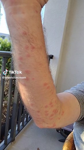 Managing No-See-Um Bites: Tips for Relief and Prevention