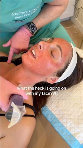 The vampire facial 🧛‍♀️👀