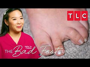 Toe Trouble | Bad Foot Clinic | TLC