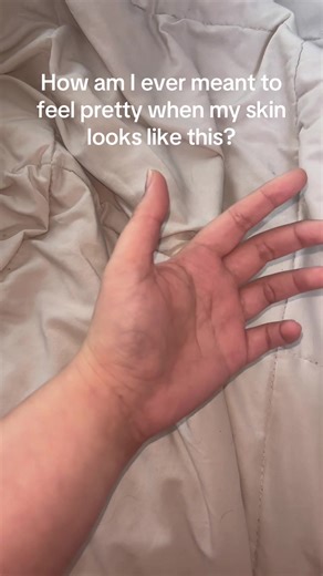 Wrinkly cuz I just got out of the bath… #ehlersdanlossyndrome causes the spider veins and bruising, #eczema and #psoriasis causes the rashes, #pcos causes the scabs from ingrown hairs.