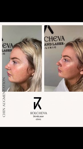 Chin augmentation with dermal filler is a non-surgical cosmetic procedure designed to enhance or reshape the chin using injectable dermal fillers, typically made of hyaluronic acid (like Juvederm or Restylane) or calcium hydroxylapatite (like Radiesse). #ChinFiller • #DermalFillers • #FacialBalancing • #NonSurgicalChinAugmentation • #ChinEnhancement • #JawlineGoals • #ProfilePerfection • #HyaluronicAcidFiller • #LiquidChinAugmentation @highlight | Susie Kolcheva Aesthetics