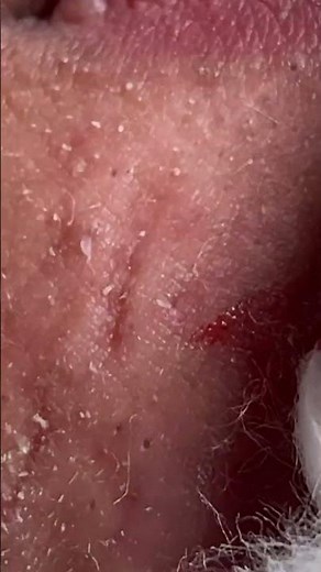 Acne Treatment Huong Da Nang# member 153#shorts