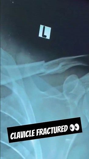 Clavicle Fracture | Physiotherapy of Fracture | Shoulder Rehabilitation | Fracture rehabilitation