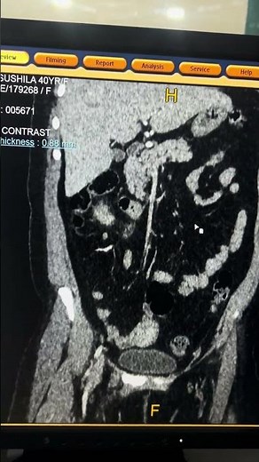Understanding Hydronephrosis of the Ureter: Symptoms and Causes