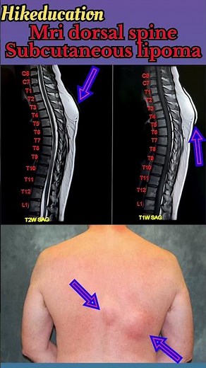 Lipoma / mri dorsal spine / subcutaneous lipoma / benign tumor / #spine #lipoma #benigntumors
