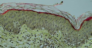 Infection of the Skin with Herpes Zoster Stock Footage - Video of research, disease: 206308758