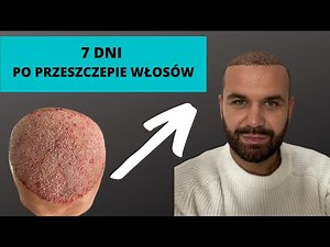 Przeszczep włosów w Turcji - RELACJA, ZDJĘCIA - 7 dni po zabiegu.