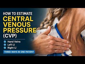 Ways to Estimate Central Venous Pressure (CVP) at the Bedside